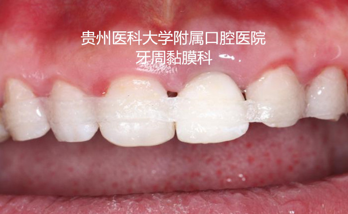 高强度纤维带松牙固定术科普知识1,松牙固定术的适应症是什么?